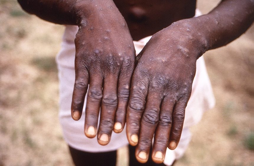 monkeypox mississippi